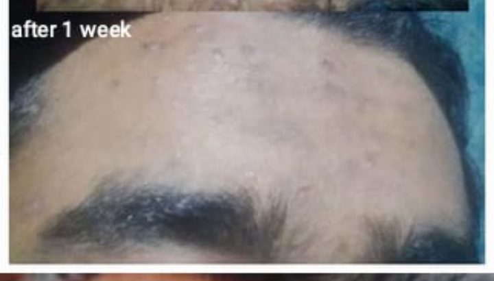 Pimple/marks removal soap